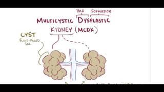 multicystic dysplastic kidney