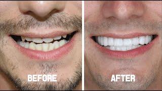 Hollywood Smile (Zirconium Crowns) - Charlie from the U.K