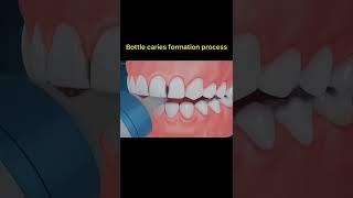 Bottle caries formation