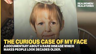 Dermatochalasis: A rare disease makes people look decades older (Documentary)