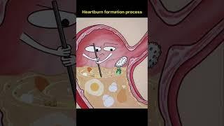 Heartburn formation process