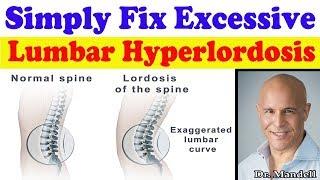 Simply Fix Excessive Lumbar Hyperlordosis - Dr Alan Mandell, DC