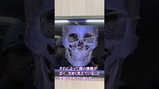 頬骨骨切りは実際どうやるの？ CTを見ながら簡単に解説（リッツ美容外科 副院長 永井 宏治）