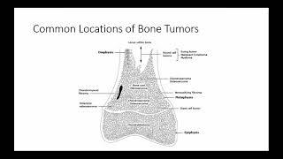 AROI WB Clinical Oncology : Bone Tumors & Soft Tissue Sarcoma