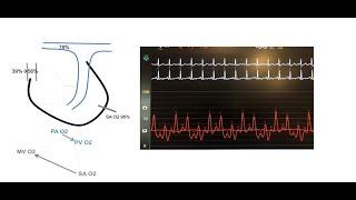 Quick assessment of cardiac shunts and quick Qp/Qs calculation- Elias Hanna, Univ of Iowa