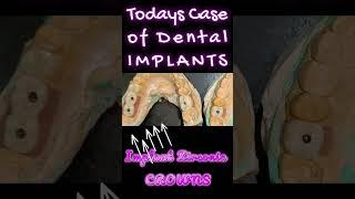 How we Implant Teeth @Bandhu Dental, Delhi #dentalimplants #dentistindelhi #braces #implantdentist