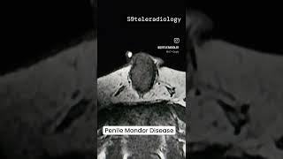 Penile #Mondor Disease- #thrombophlebitis of dorsal vein of #penis  #peniletrauma #s9teleradiology