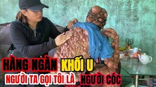 Người đàn ông có hơn 1.000 khối u mụn thịt trên cơ thể. Sống ở Xứ Nẫu Phú Yên