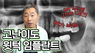 상악동과 가까워서 골폭이 좁은 경우 이 방법으로 임플란트 하셔야 합니다