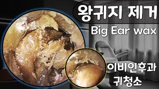 [귀팡] 왕귀지 청소 Big Ear wax removal (초고화질 HD endoscope)