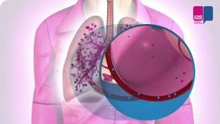 Longontsteking - wat gebeurt er in je longen?