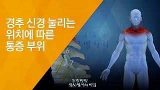 경추 신경 눌리는 위치에 따른 통증 부위 - (20140917_517회 방송)_우리 몸이 흔들린다 목 질환의 경고!