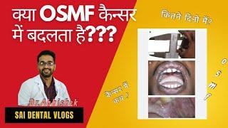 OSMF KYA CANCER MEY BADALTA HAI?  ओ एस एम एफ कैंसर मे कितने दिनों मे बदलता है