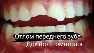 Доктор стоматолог, у меня откололся передний зуб. Что делать? Лечение зуба с помощью штифта и пломбы