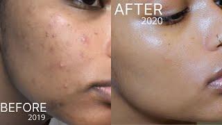 Affordable Skincare Routine for Acne Scars & Hyperpigmentation