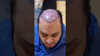 Arif Khan Hybrid FUE DHI Hair Transplant