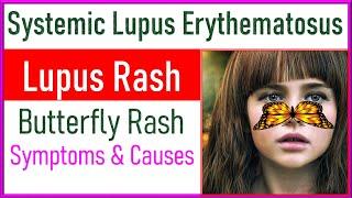 Systemic Lupus Erythematosus Disease | Lupus Rash Disease | Signs Symptoms and Causes