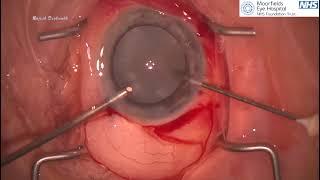 Bimanual automated decompression of white intumescent cataracts “ Deshmukh Technique “