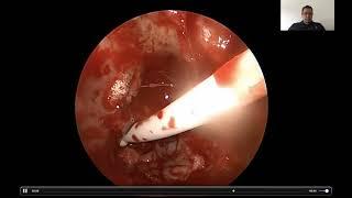 Carotid Artery In Anterior Skull Base Surgery - SPANISH