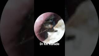 Alive Black flying Insect Inside Ear   #doctor #entspecialist #shortvideo #shorts