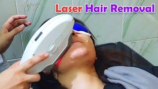 Facial Hair Removal by Laser in a Patient with Hirsutism | Permanent Hair Growth Reduction