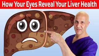 How Your Eyes Reveal Your Liver Health!  Dr. Mandell