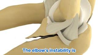 Stability of Elbow Fracture & Dislocation : UCL and Coronoid Repair 팔꿈치 골절탈구:내측 인대와 구상돌기 고정의 핵심