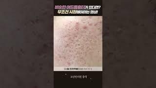 나랑 비슷한 피부여드름흉터 제거 되었다구?!  #박스카 #박스카흉터 #Boxcar #여드름흉터 #볼여드름흉터 #볼패인흉터 #남자여드름흉터 #새살침