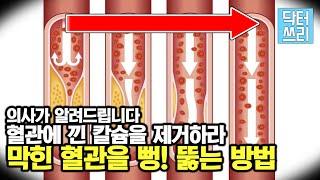 혈관에 낀 "칼슘"을 제거하라 - 막힌 혈관을 뻥 뚫어줄 "1인자"는?