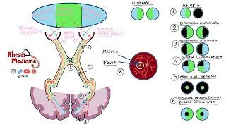 Visual Field Defects and Optic Nerve Pathway |  Homonymous Hemianopia Bitemporal Hemianopia NEW 2020