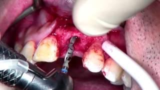 Step by Step Anterior Implant placement with GBR (with voiceover)