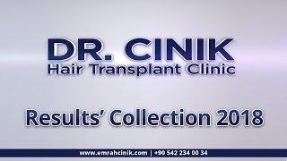 Hair Transplant Turkey - Hair Transplant Istanbul Results 2018 & 2019 Dr. Emrah Cinik