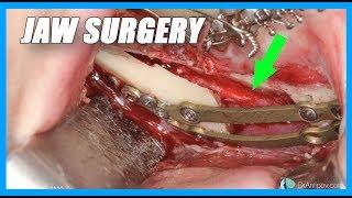 JAW SURGERY