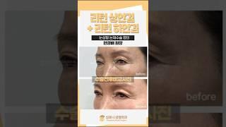 상안검 , 하안검수술 같이해서 10년이상 젊어진 케이스 스터디