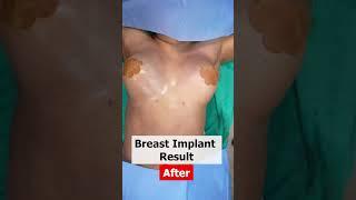 Breast implant surgery | Breast Implant Surgery cost | Breast Augmentation result #shorts