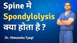 Spine मे Spondylolysis क्या होता है ? | Dr. Himanshu Tyagi