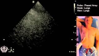 Evaluating the Lungs using Ultrasound