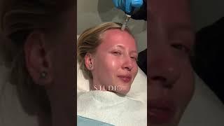 StudioMD - Vampiral Facial (PRP + Microneedling)