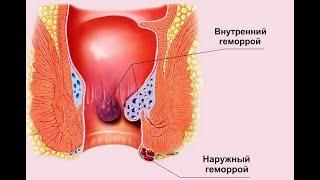 Как вылечить наружный геморрой. Метилурацил, детралекс.