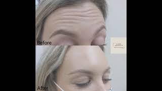 Anti-wrinkle treatment