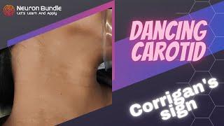 Corrigan’s sign : Dancing carotid pulse #Aorticregurgitation #CVS