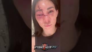 CRAZY! UFC Fighter Irene Aldana shows stitches from her BRUTAL CUT!