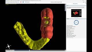 BSPV4.11: Crown Down Implant Planning with Immediate Load Crown Design