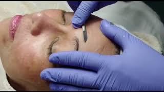 Dermaplaning for smooth and hair free face