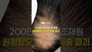 200만 유튜버 조재원님 원형탈모 시술 결과 #탈모 #원형탈모 #인천탈모 #줄기세포 #엑소좀