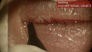 Successful Electrolysis of  Trichiasis using OcuRF