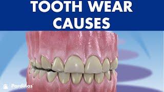 Tooth erosion, abfraction, attrition and other dental wear ©