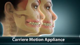 Carriere Motion Orthodontic Treatment | Curveia Dental Animation | Patient Education Video