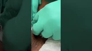 Abdominal Wall Abscess