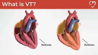 What is Ventricular Tachycardia (VT)?